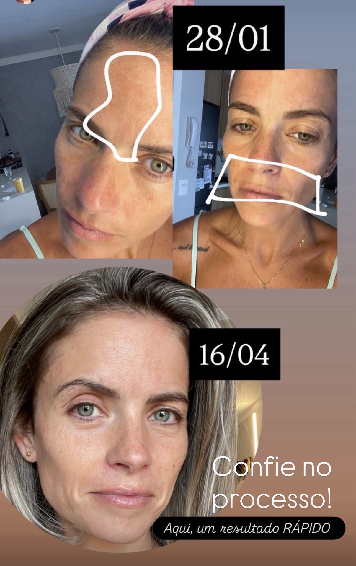 Antes e depois do cuidado com melasma
